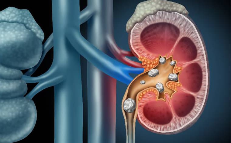 Cálculos renales (litiasis renal)