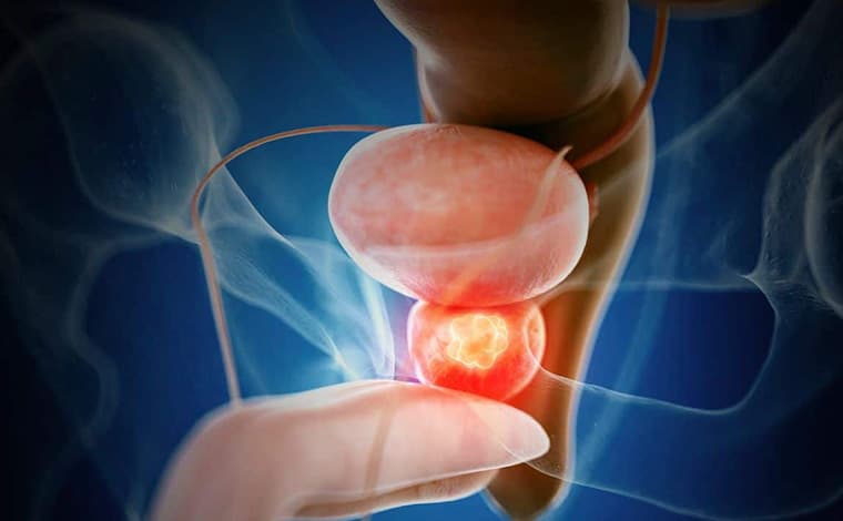 Cáncer de próstata