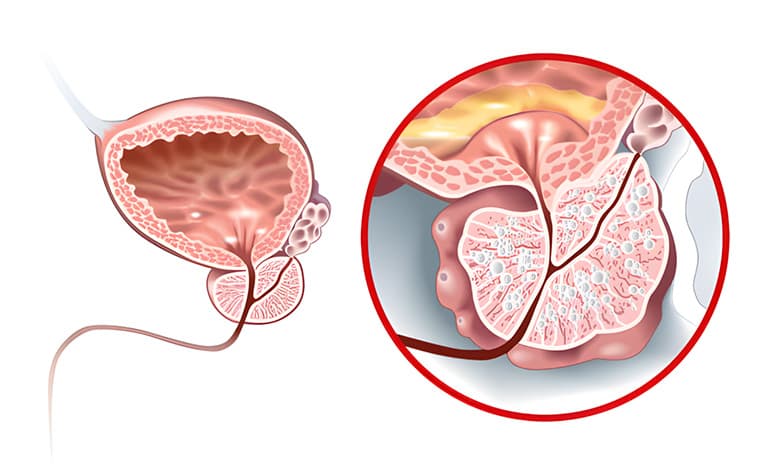 Hiperplasia prostática benigna (HPB)